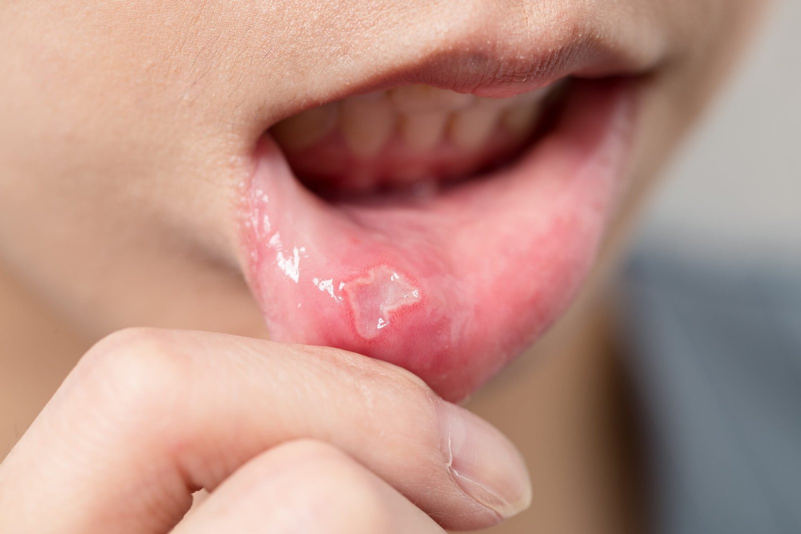 Cold Sores: Symptoms, Causes & How to Get Rid of Them Fast
