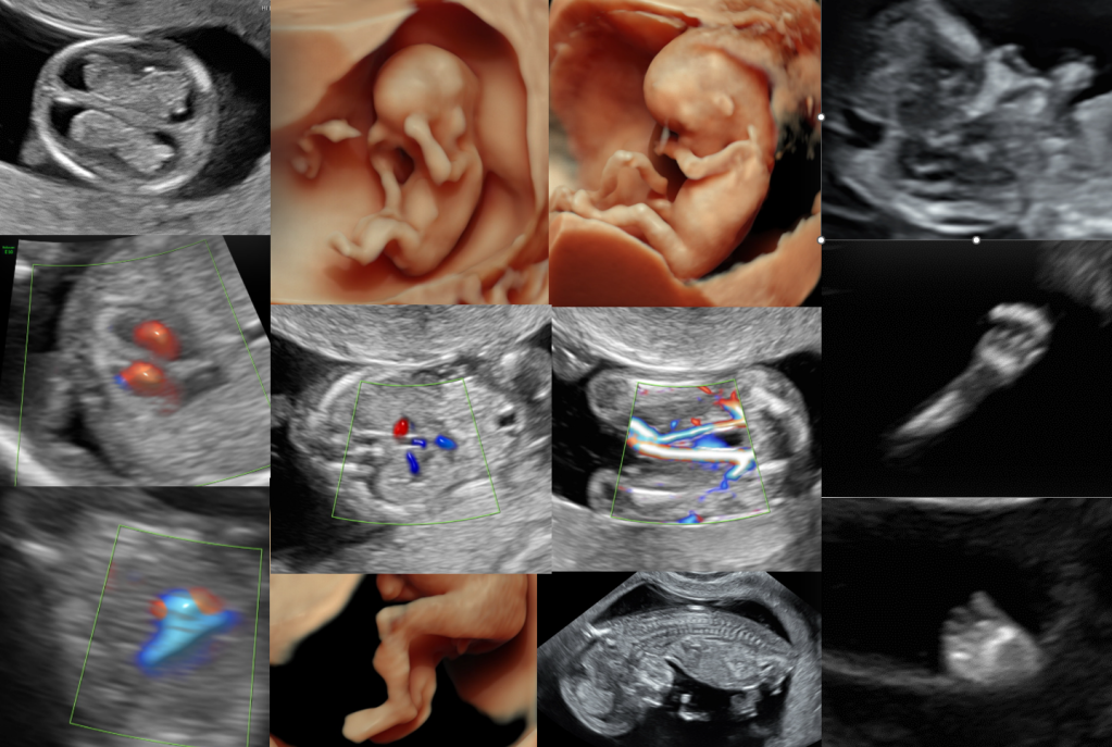 First Trimester of Pregnancy (Weeks 2–12) Symptoms, Baby Growth & Diet Guide