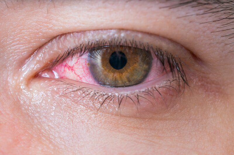 How to Spot & Treat Conjunctivitis: Symptoms, Types & Home Remedies