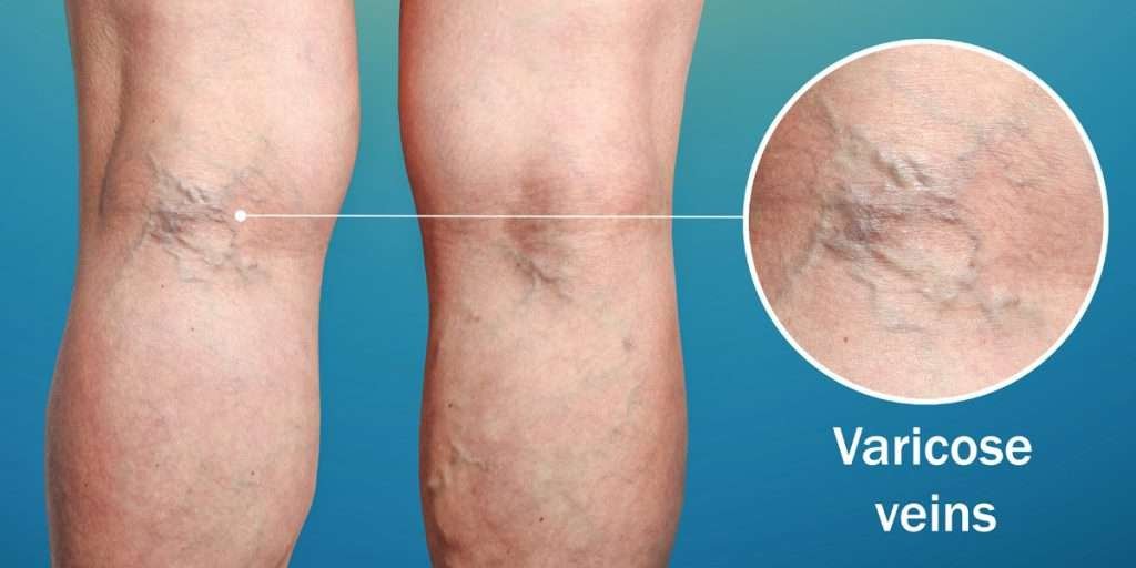 How to Get Rid of Varicose Veins Naturally Causes, Remedies & Treatments