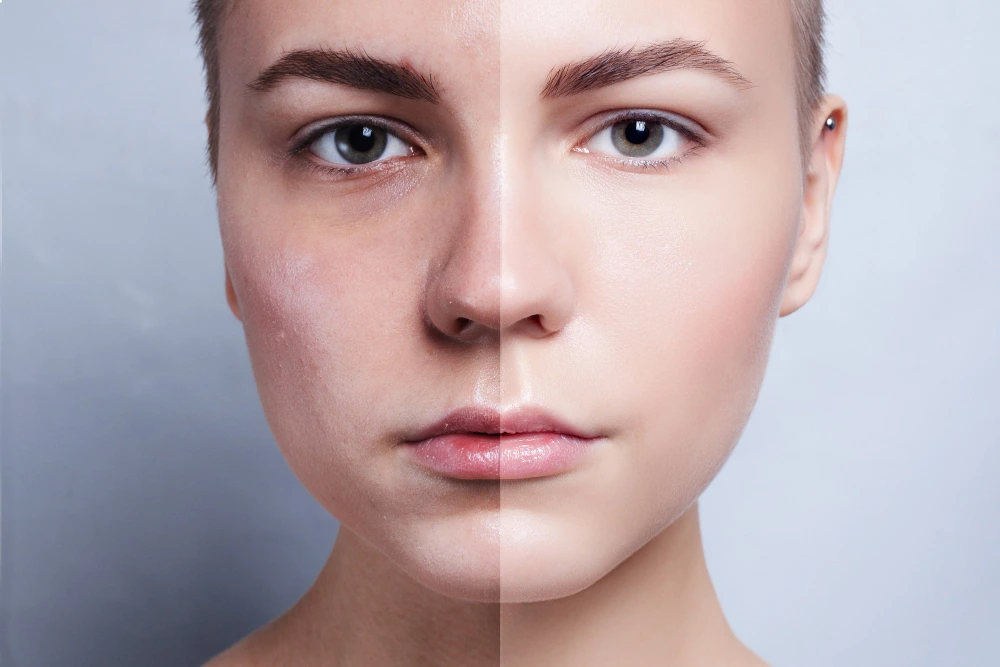 How to Reduce Melanin in Skin Naturally Remedies, Diet & Lifestyle Tips